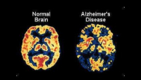 Při Alzheimerově nemoci se do mozku ukládají špatně svinuté či poškozené bílkoviny beta-amyloid a tau protein.  /Obr.: chm.bris.ac.uk/